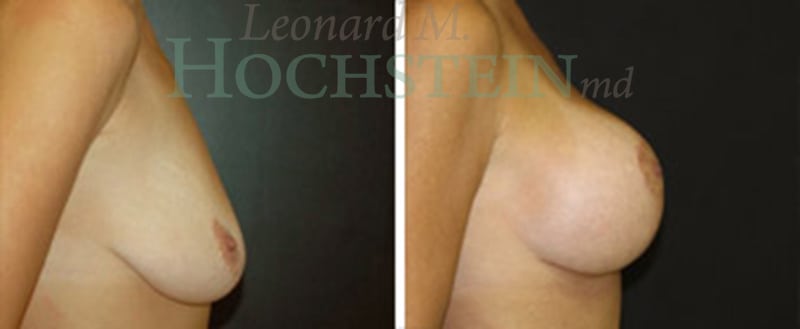 Breast Lift With Implants Patient
