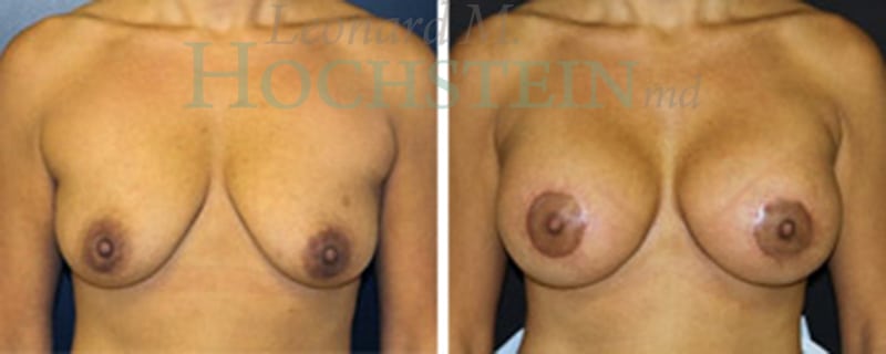 Breast Lift With Implants Patient