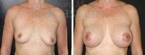 Breast Lift With Implants Patient