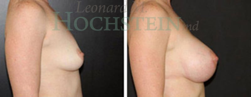 Breast Lift With Implants Patient