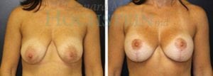 Breast Lift With Implants Patient
