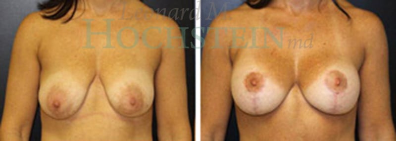 Breast Lift With Implants Patient