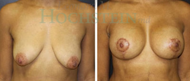 Breast Lift With Implants Patient