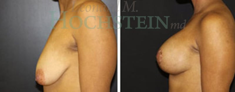 Breast Lift With Implants Patient