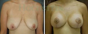 Breast Lift With Implants Patient