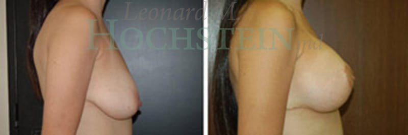 Breast Lift With Implants Patient