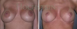 Breast Lift Patient 94