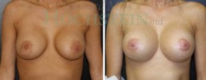 Breast Lift With Implants Patient