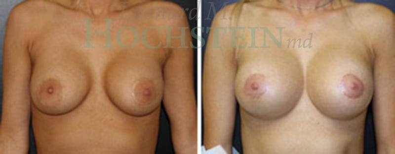 Breast Lift With Implants Patient