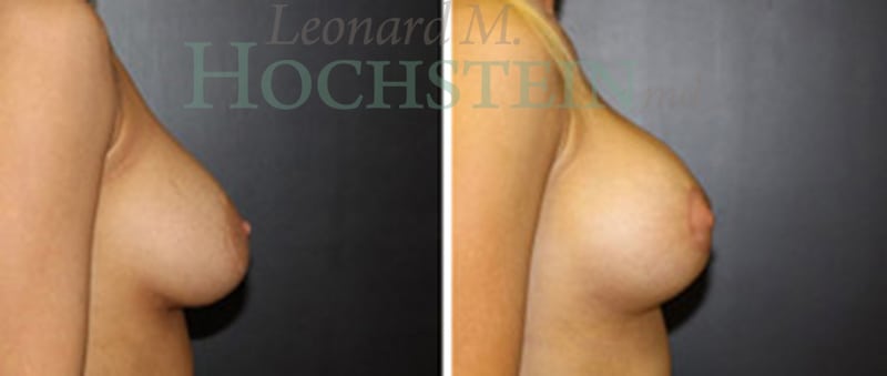 Breast Lift With Implants Patient