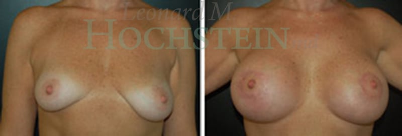 Breast Lift With Implants Patient