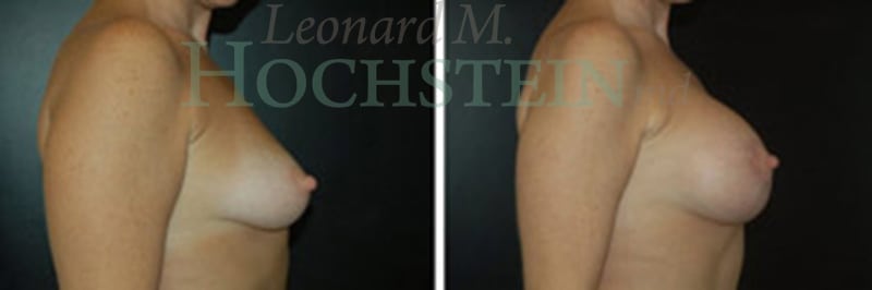 Breast Lift With Implants Patient