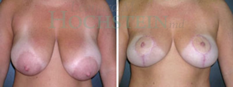 Breast Lift With Implants Patient