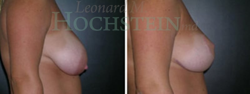 Breast Lift With Implants Patient