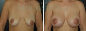 Breast Lift With Implants Patient