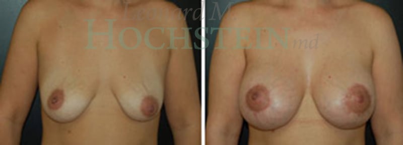 Breast Lift With Implants Patient