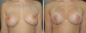 Breast Lift With Implants Patient