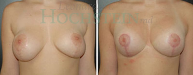 Breast Lift With Implants Patient