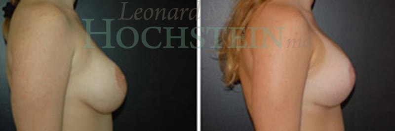 Breast Lift With Implants Patient