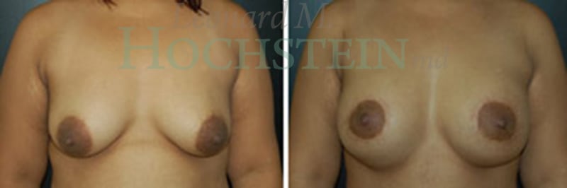 Breast Lift With Implants Patient