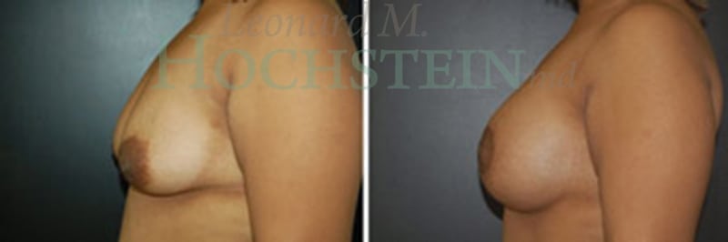 Breast Lift With Implants Patient