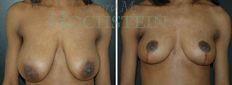 Breast Lift With Implants Patient