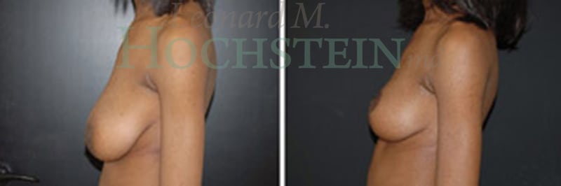 Breast Lift With Implants Patient