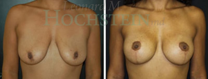 Breast Lift With Implants Patient