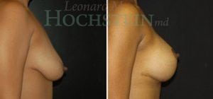 Breast Lift With Implants Patient