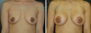 Breast Lift With Implants Patient
