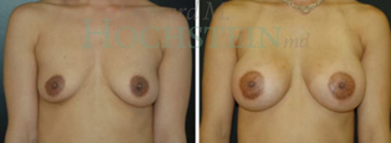 Breast Lift With Implants Patient