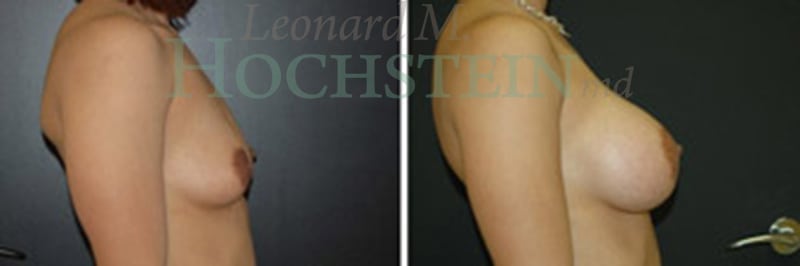 Breast Lift With Implants Patient