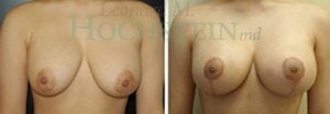 Breast Lift With Implants Patient