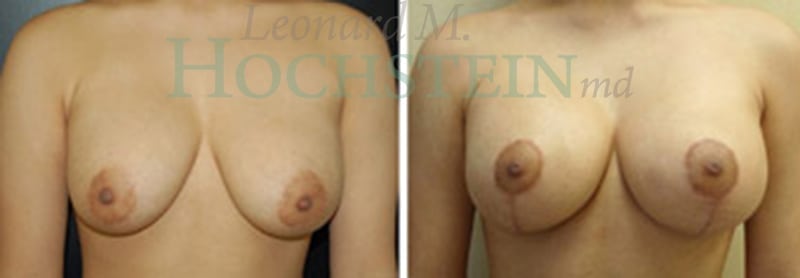 Breast Lift With Implants Patient