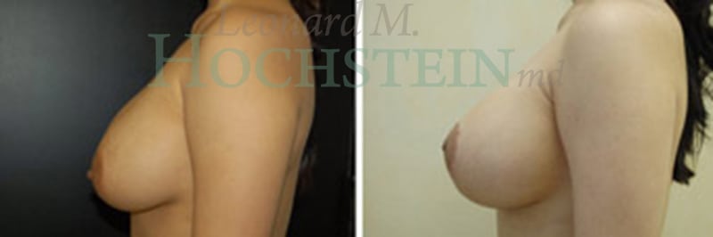 Breast Lift With Implants Patient