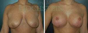 Breast Lift With Implants Patient