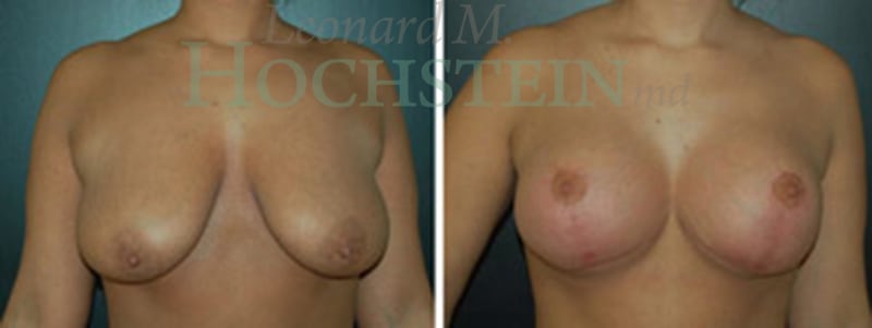 Breast Lift With Implants Patient