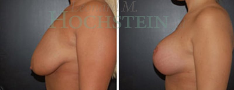 Breast Lift With Implants Patient