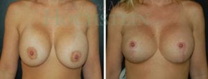 Breast Lift With Implants Patient
