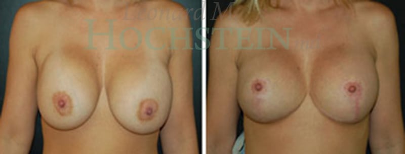 Breast Lift With Implants Patient