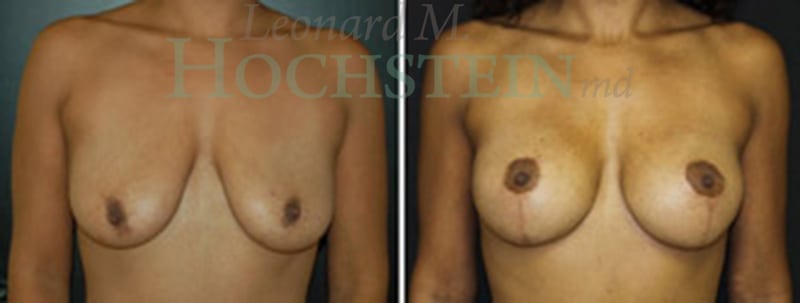 Breast Lift With Implants Patient
