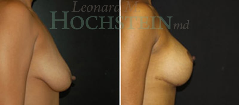Breast Lift With Implants Patient
