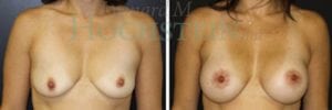 Breast Lift With Implants Patient
