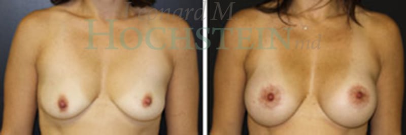 Breast Lift With Implants Patient