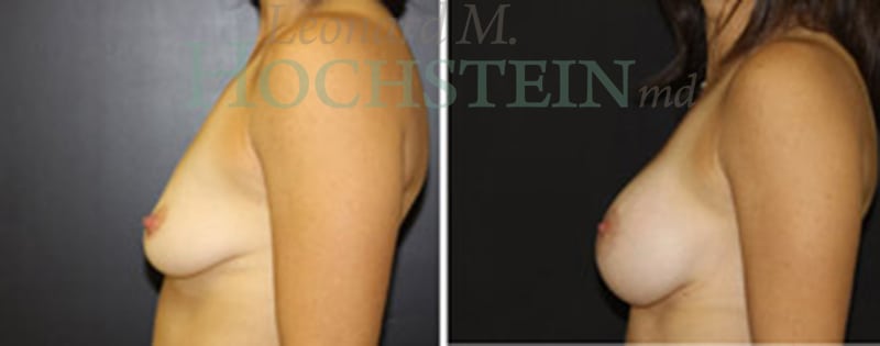 Breast Lift With Implants Patient