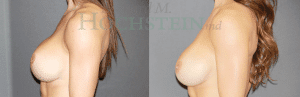 Breast Lift With Implants Patient