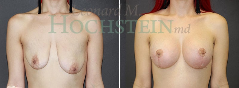 Breast Lift With Implants Patient