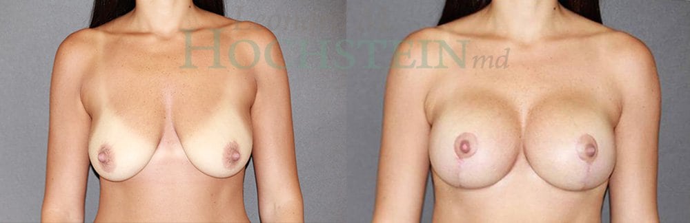 Breast Lift With Implants Patient