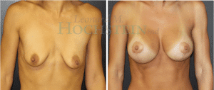 Breast Lift With Implants Patient