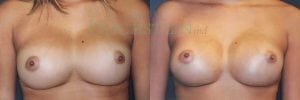 Breast Revision Patient